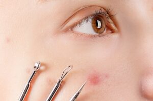 how to remove pimple in face naturally